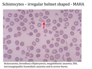 Schistocytes – irregular helmet shaped - MAHA
thalassaemia, hereditary elliptocytosis, megaloblastic anaemia, IDA,
microangiopathic haemolytic anaemia and in severe burns.
 