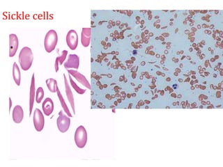 Sickle cells
 