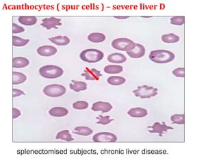 Acanthocytes ( spur cells ) – severe liver D
splenectomised subjects, chronic liver disease.
 