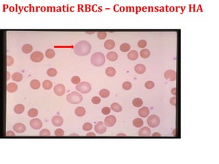 Polychromatic RBCs – Compensatory HA
 