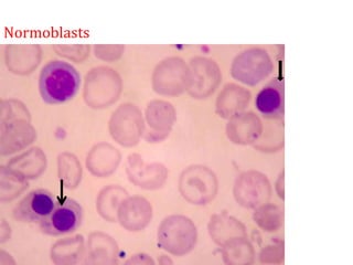 Normoblasts
 