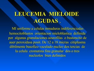 LEUCEMIA MIELOIDELEUCEMIA MIELOIDE
AGUDASAGUDAS ..
MI uniforme a celulas inmaduras indiferenciadasMI uniforme a celulas inmaduras indiferenciadas
hemocitoblastos orientacion mieloblastica definidahemocitoblastos orientacion mieloblastica definida
por algunas granulaciones azurofilas o bastoncito depor algunas granulaciones azurofilas o bastoncito de
auer peroxidasa posit. De 12 a 18 micras citiplasmaauer peroxidasa posit. De 12 a 18 micras citiplasma
dibilmente basofico vaculado nucleo dos tercias dedibilmente basofico vaculado nucleo dos tercias de
la celula cromatina fina granular dos o tresla celula cromatina fina granular dos o tres
nucleolos bien definidosnucleolos bien definidos
 