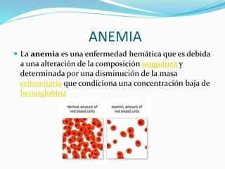 ANEMIA 
 La anemia es una enfermedad hemática que es debida 
a una alteración de la composición sanguínea y 
determinada por una disminución de la masa 
eritrocitaria que condiciona una concentración baja de 
hemoglobina 
 