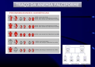 TRAÇO DA ANEMIA FALCIFORME
 