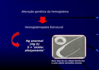 Alteração genética da hemoglobina
Hemoglobinopatia Estrutural
Hg anormal
(Hg S)
S = ‘sickle:
afoiçamento’
Rara foto de um célula falciforme
e uma célula vermelha normal.
 