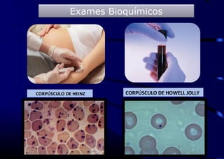 CORPÚSCULO DE HOWELL JOLLYCORPÚSCULO DE HEINZ
Exames Bioquímicos
 