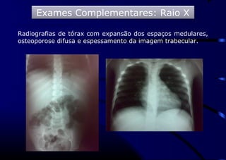 Radiografias de tórax com expansão dos espaços medulares,
osteoporose difusa e espessamento da imagem trabecular.
Exames Complementares: Raio X
 