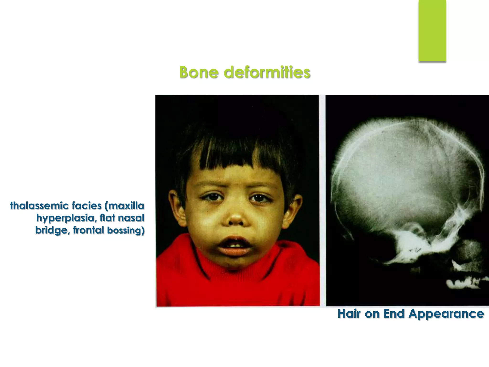 thalassemic facies (maxilla
hyperplasia, ﬂat nasal
bridge, frontal bossing)
Hair on End Appearance
Bone deformities
 
