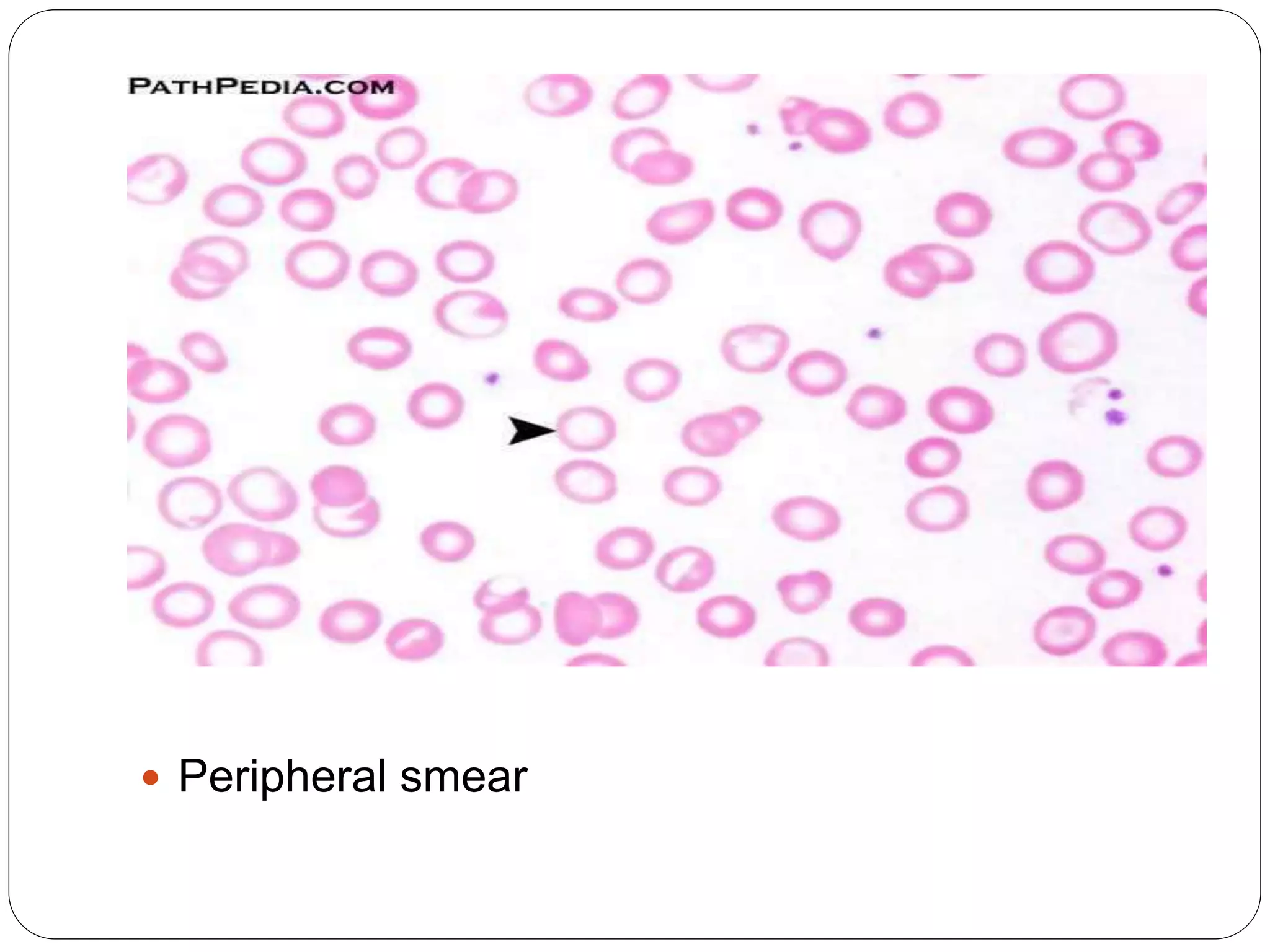  Peripheral smear
 