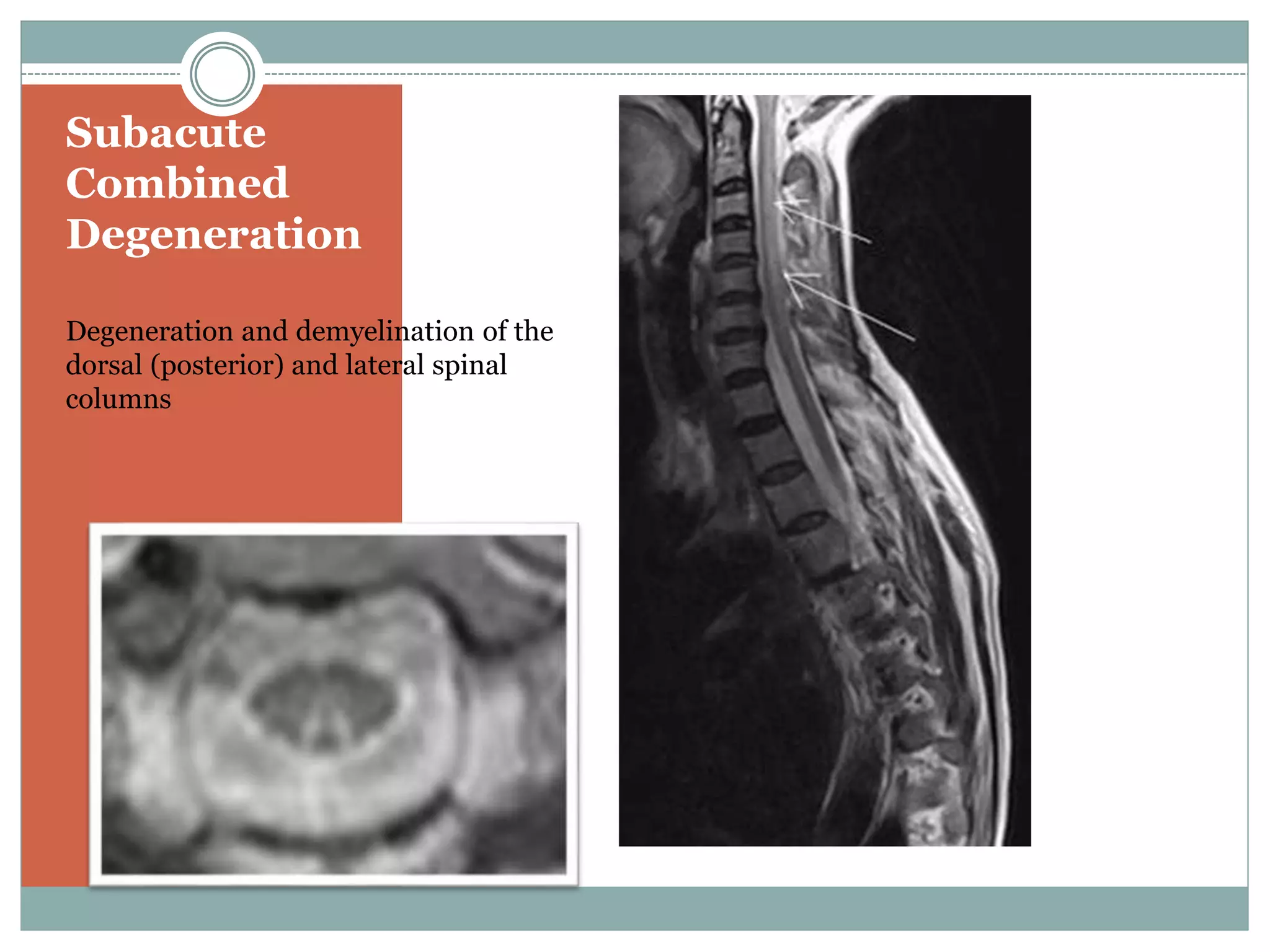 Subacute
Combined
Degeneration
Degeneration and demyelination of the
dorsal (posterior) and lateral spinal
columns
 