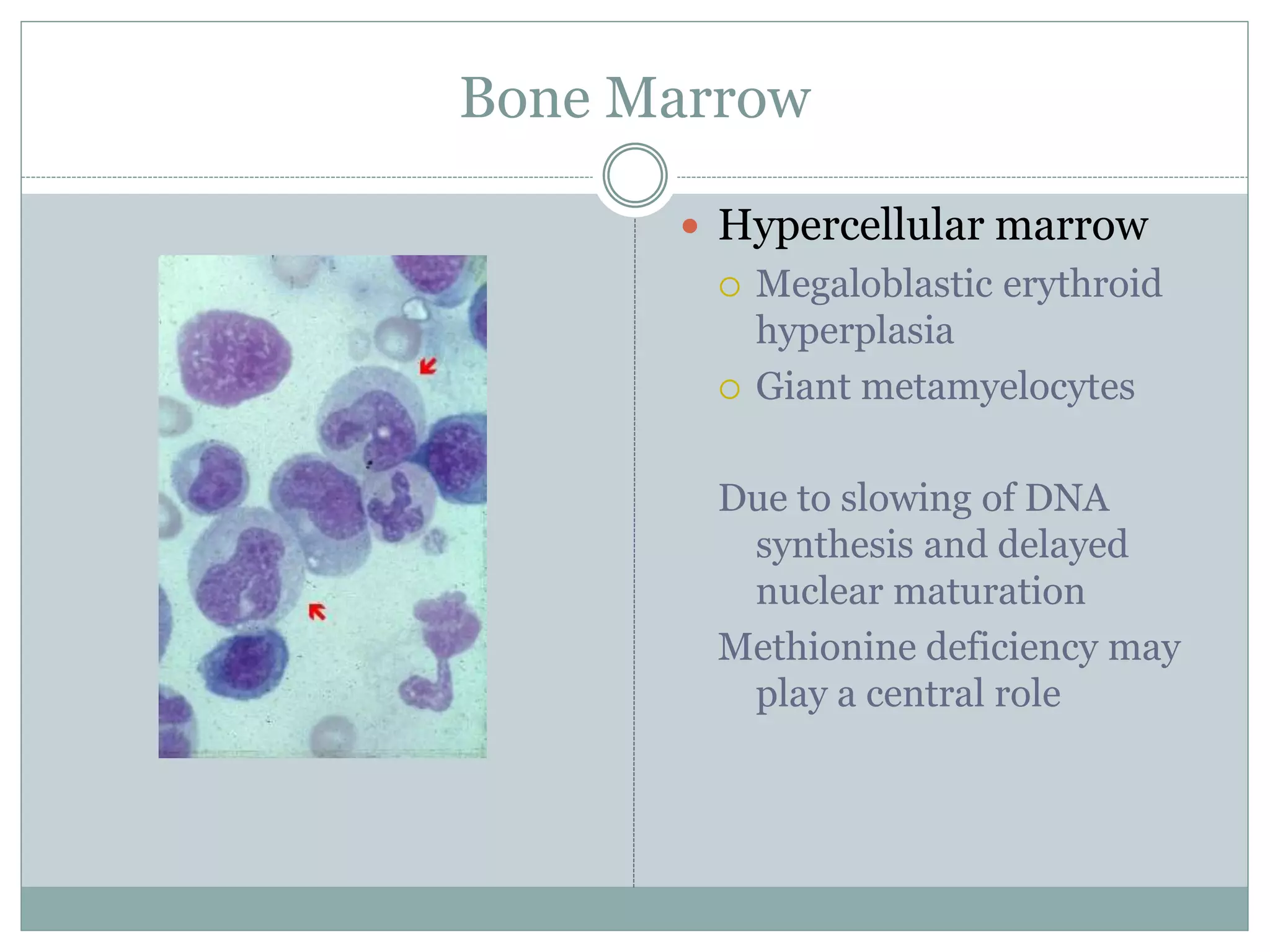 Bone Marrow
 Hypercellular marrow
 Megaloblastic erythroid
hyperplasia
 Giant metamyelocytes
Due to slowing of DNA
synthesis and delayed
nuclear maturation
Methionine deficiency may
play a central role
 