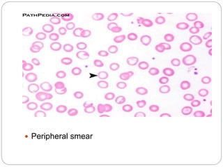  Peripheral smear
 