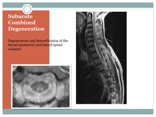 Subacute
Combined
Degeneration
Degeneration and demyelination of the
dorsal (posterior) and lateral spinal
columns
 