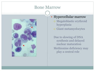 Bone Marrow
 Hypercellular marrow
 Megaloblastic erythroid
hyperplasia
 Giant metamyelocytes
Due to slowing of DNA
synthesis and delayed
nuclear maturation
Methionine deficiency may
play a central role
 
