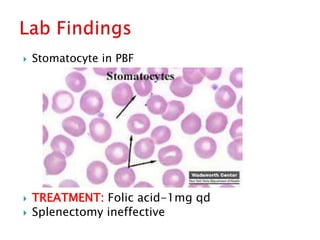  Stomatocyte in PBF
 TREATMENT: Folic acid-1mg qd
 Splenectomy ineffective
 
