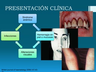 PRESENTACIÓN CLÍNICA
Sindrome
anémico

Hemorragia en
piel o mucosas

Infecciones

Alteraciones
visuales

British journal of haematology 2009;147:43-

 