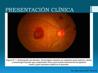 PRESENTACIÓN CLÍNICA

Rev Med Hered 2007;18:45-48

 