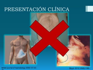 PRESENTACIÓN CLÍNICA

British journal of haematology 2009;147:43-

Blood. 2012;120(6):1185-

 