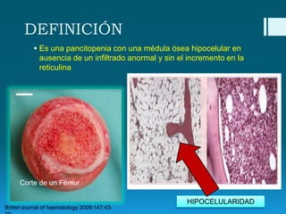 DEFINICIÓN
 Es una pancitopenia con una médula ósea hipocelular en
ausencia de un infiltrado anormal y sin el incremento en la
reticulina

Corte de un Fémur

British journal of haematology 2009;147:43-

HIPOCELULARIDAD

 