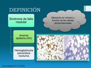 DEFINICIÓN
Sindrome de falla
medular

Anemia
aplásica (AA)

Hemoglobinuria
paroxística
nocturna

Cancerologia 2011; 6:125-28

Alteración en número y
función de las células
pluripontenicales

 
