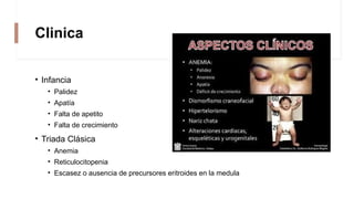 Clinica
• Infancia
• Palidez
• Apatía
• Falta de apetito
• Falta de crecimiento
• Triada Clásica
• Anemia
• Reticulocitopenia
• Escasez o ausencia de precursores eritroides en la medula
 