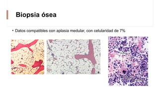 Biopsia ósea
• Datos compatibles con aplasia medular, con celularidad de 7%
 