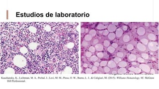 Estudios de laboratorio
SANGRE PERIFÉRICA
PANCITOPENIA
• Frotis muestra eritrocitos grandes y
escasez de plaquetas y
granulocitos
• Aumenta el volumen globular
medio
• Reticulocitos están disminuidos o
ausentes
• Linfocitos puede ser normal o baja
MÉDULA ÓSEA
Por medio de biopsia
• Es adiposa
• Pálida
• Células hematopoyéticas ocupan <25%
del espacio medular
• Células hematopoyéticas residuales
suelen tener morfología normal
• Ligera eritropoyesis
megaloblástica
• Megacariocitos disminuidos
Kaushansky, K., Lichtman, M. A., Prchal, J., Levi, M. M., Press, O. W., Burns, L. J., & Caligiuri, M. (2015). Williams Hematology, 9E. McGraw
Hill Professional.
 
