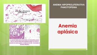 Anemia
aplásica
ANEMIA HIPOPROLIFERATIVA
PANCITOPENIA
 