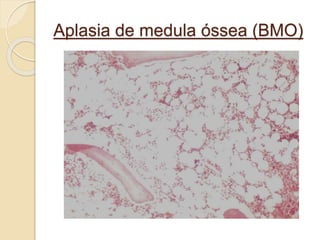 Aplasia de medula óssea (BMO) 
 