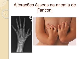 Alterações ósseas na anemia de 
Fanconi 
 