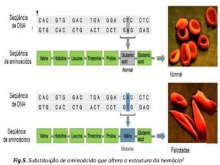 Fig.5. Substituição de aminoácido que altera a estrutura da hemácia2
 