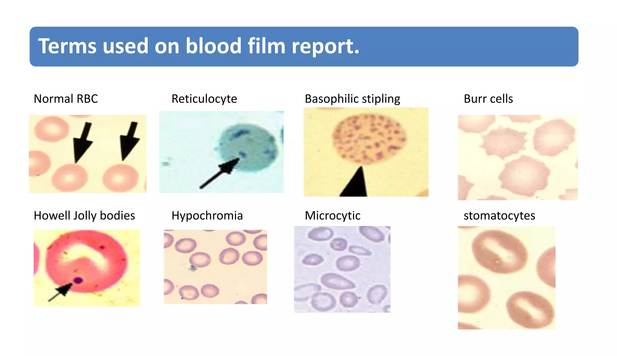 Normal RBC Reticulocyte Basophilic stipling Burr cells
Howell Jolly bodies Hypochromia Microcytic stomatocytes
Terms used on blood film report.
 