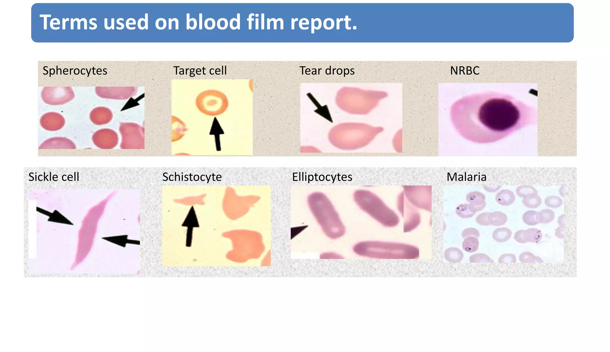 Spherocytes Target cell Tear drops NRBC
Sickle cell Schistocyte Elliptocytes Malaria
Terms used on blood film report.
 