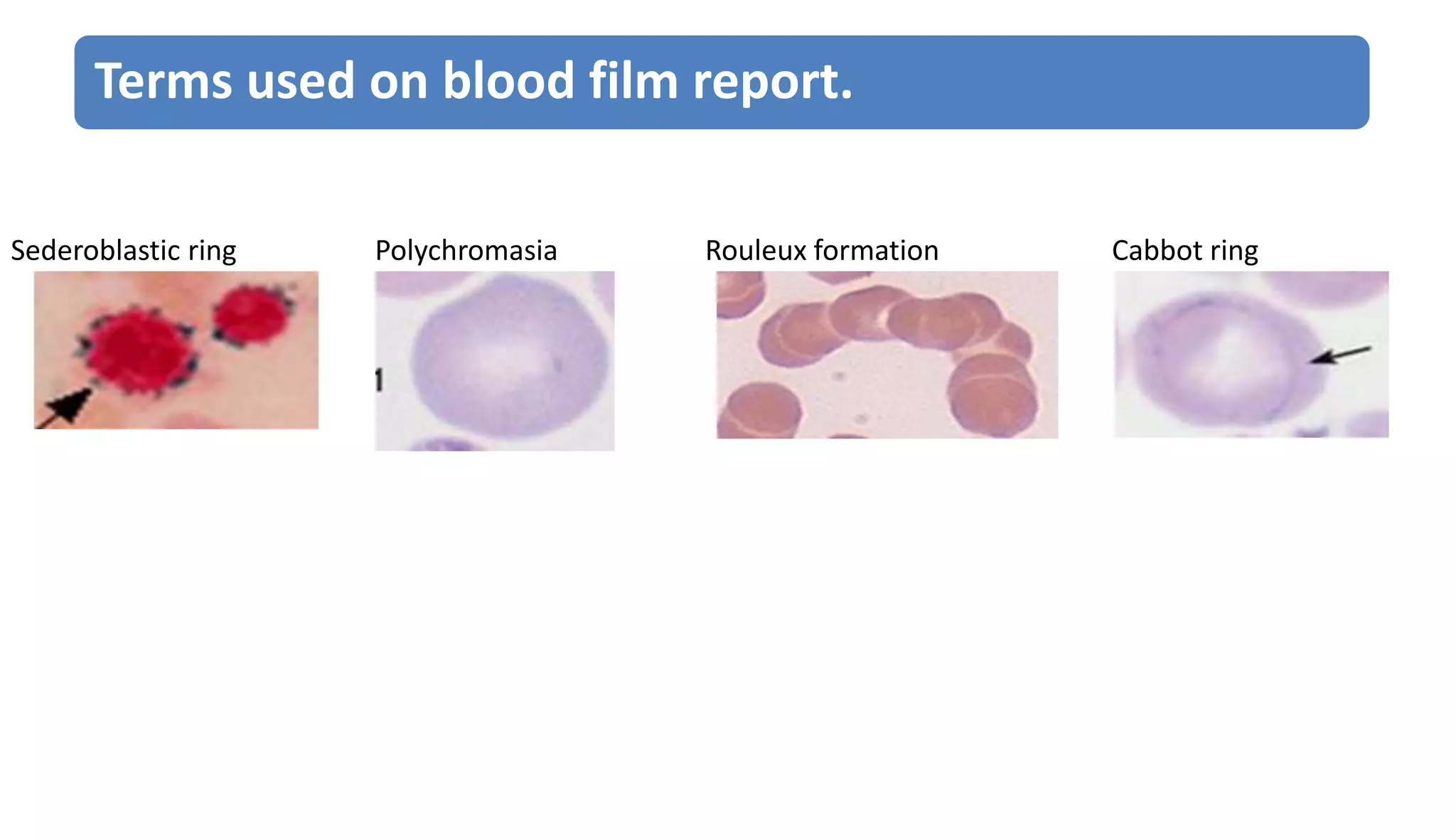 Sederoblastic ring Polychromasia Rouleux formation Cabbot ring
Terms used on blood film report.
 