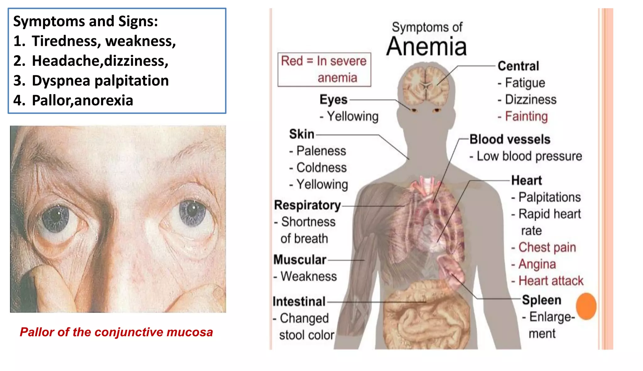 Symptoms and Signs:
1. Tiredness, weakness,
2. Headache,dizziness,
3. Dyspnea palpitation
4. Pallor,anorexia
Pallor of the conjunctive mucosa
 