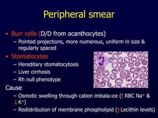Peripheral smear
• Burr cells (D/D from acanthocytes)
– Pointed projections, more numerous, uniform in size &
regularly spaced
• Stomatocytes
– Hereditary stomatocytosis
– Liver cirrhosis
– Rh null phenotype
Cause
– Osmotic swelling through cation imbalance ( RBC Na+ &
K+)
– Redistribution of membrane phospholipid ( Lecithin levels)
 