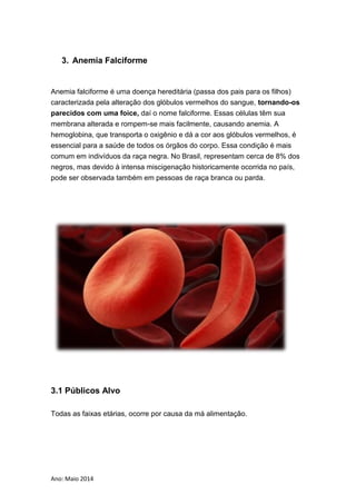 Ano: Maio 2014
3. Anemia Falciforme
Anemia falciforme é uma doença hereditária (passa dos pais para os filhos)
caracterizada pela alteração dos glóbulos vermelhos do sangue, tornando-os
parecidos com uma foice, daí o nome falciforme. Essas células têm sua
membrana alterada e rompem-se mais facilmente, causando anemia. A
hemoglobina, que transporta o oxigênio e dá a cor aos glóbulos vermelhos, é
essencial para a saúde de todos os órgãos do corpo. Essa condição é mais
comum em indivíduos da raça negra. No Brasil, representam cerca de 8% dos
negros, mas devido à intensa miscigenação historicamente ocorrida no país,
pode ser observada também em pessoas de raça branca ou parda.
3.1 Públicos Alvo
Todas as faixas etárias, ocorre por causa da má alimentação.
 