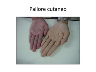 Pallore cutaneo

 