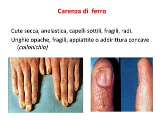 Carenza di ferro
Cute secca, anelastica, capelli sottili, fragili, radi.
Unghie opache, fragili, appiattite o addirittura concave
(coilonichia)

 