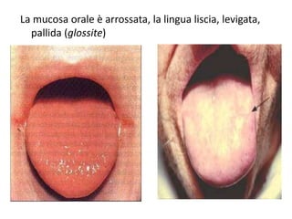 La mucosa orale è arrossata, la lingua liscia, levigata,
pallida (glossite)

 