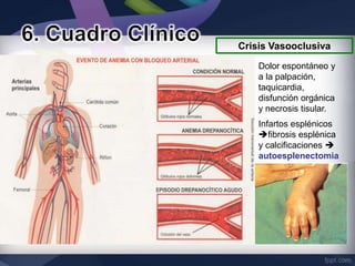 Crisis Vasooclusiva
    Dolor espontáneo y
    a la palpación,
    taquicardia,
    disfunción orgánica
    y necrosis tisular.
    Infartos esplénicos
    fibrosis esplénica
    y calcificaciones 
    autoesplenectomia
 