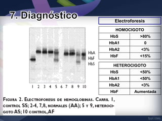 Electroforesis
  HOMOCIGOTO
HbS          >80%
HbA1           0
HbA2          <3%
HbF          <15%

 HETEROCIGOTO
HbS          <50%
HbA1         <50%
HbA2          <3%
HbF        Aumentada
 