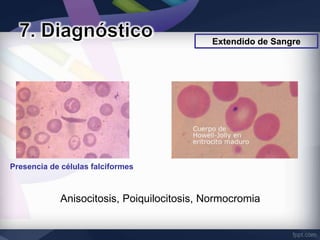Extendido de Sangre




Presencia de células falciformes



             Anisocitosis, Poiquilocitosis, Normocromia
 