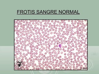 FROTIS SANGRE NORMALFROTIS SANGRE NORMAL
 