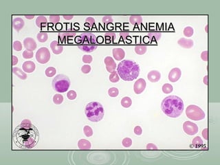 FROTIS SANGRE ANEMIAFROTIS SANGRE ANEMIA
MEGALOBLASTICAMEGALOBLASTICA
 