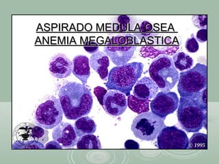 ASPIRADO MEDULA OSEAASPIRADO MEDULA OSEA
ANEMIA MEGALOBLASTICAANEMIA MEGALOBLASTICA
 