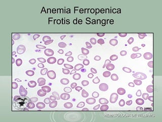 Anemia FerropenicaAnemia Ferropenica
Frotis de SangreFrotis de Sangre
HEMATOLOGIA DE WILLIAMSHEMATOLOGIA DE WILLIAMS
 