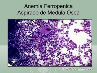 Anemia FerropenicaAnemia Ferropenica
Aspirado de Medula OseaAspirado de Medula Osea
HEMATOLOGIA DE WILLIAMSHEMATOLOGIA DE WILLIAMS
 