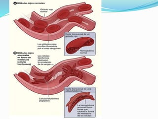 Anemia drepanocítica | PPTX