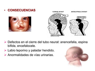 • CONSECUENCIAS
 Defectos en el cierre del tubo neural: anencefalia, espina
bífida, encefalocele.
 Labio leporino y paladar hendido.
 Anormalidades de vías urinarias.
 